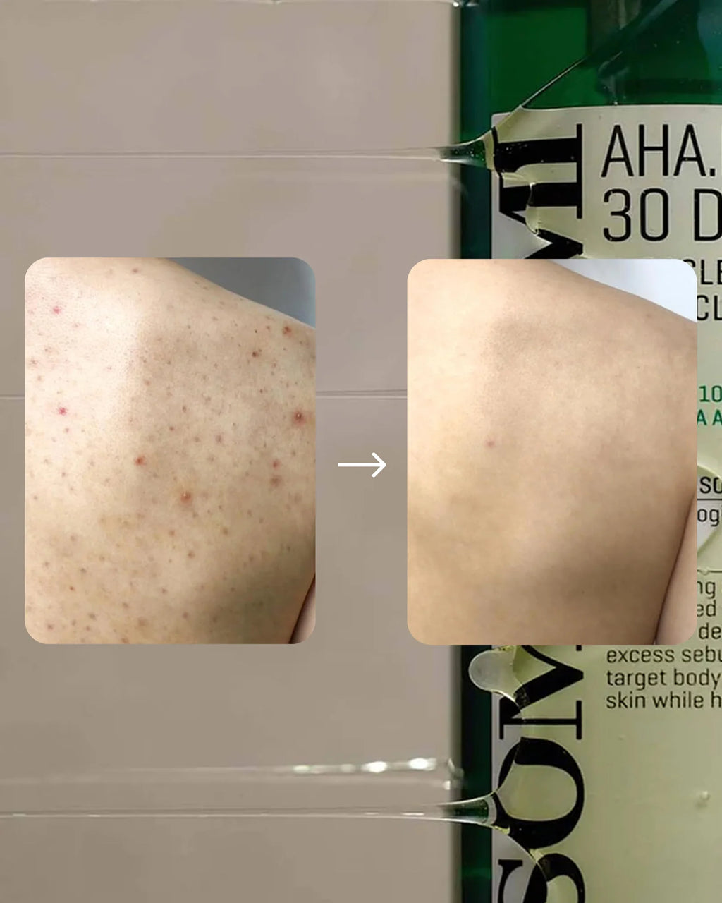 AHA BHA PHA 30 Days Miracle Acne Clear Body Cleanser
